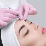 Trẻ hóa nâng cơ xía nhăn vùng trán 60 phút